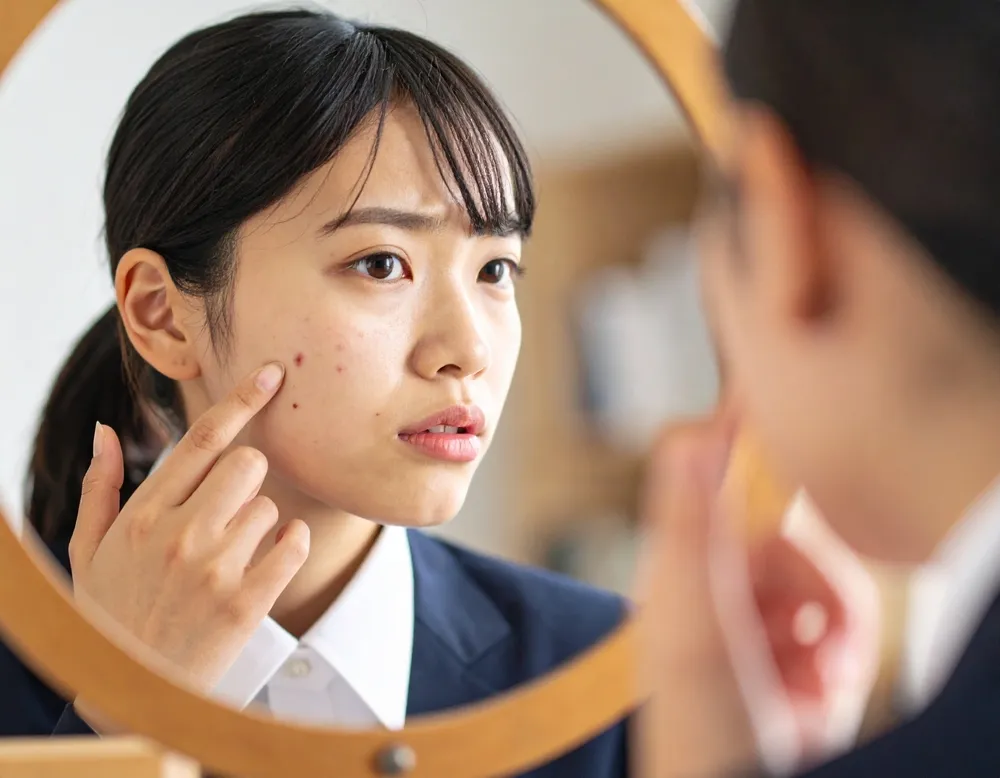 【ニキビ占い】場所別の意味と噂の真相を薬剤師がこっそり解説